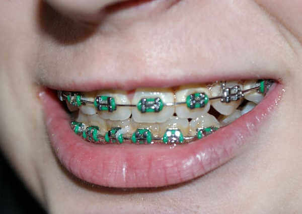 Best orthodontist in Perth's northern suburbs with the latest dental braces technology options in Perth.