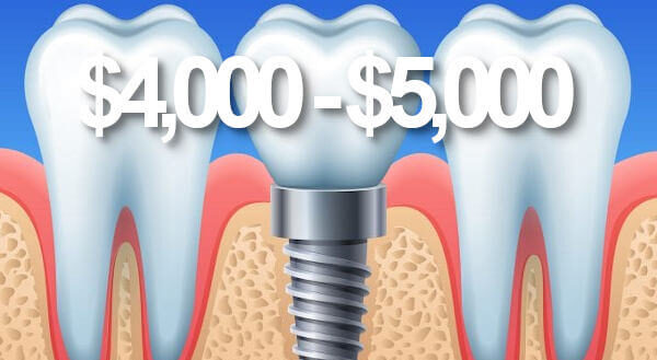 2024 price of dental implants in Perth
