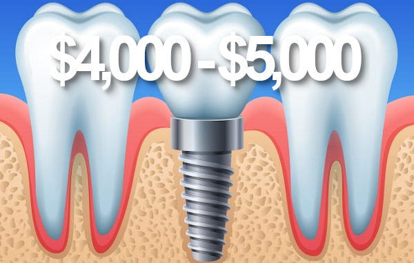 Price of dental implants in Perth