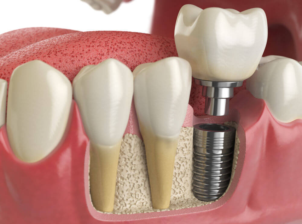 Free dental implant checkup appointment Perth.