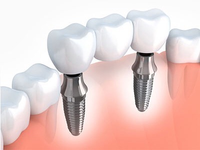 Dental implant service Perth.