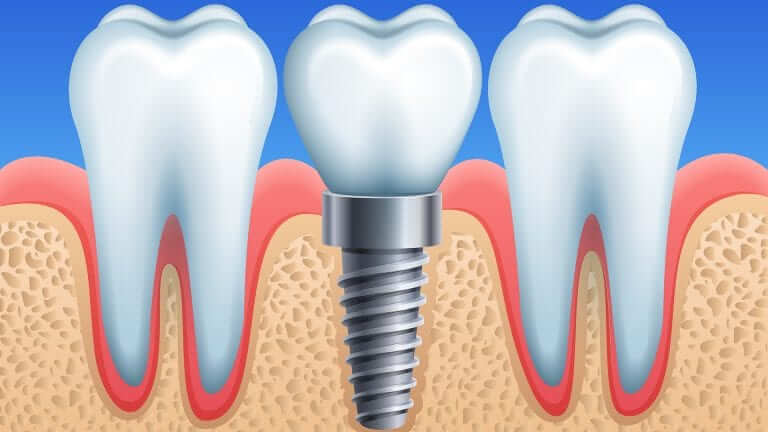 Dental implant Brisbane.