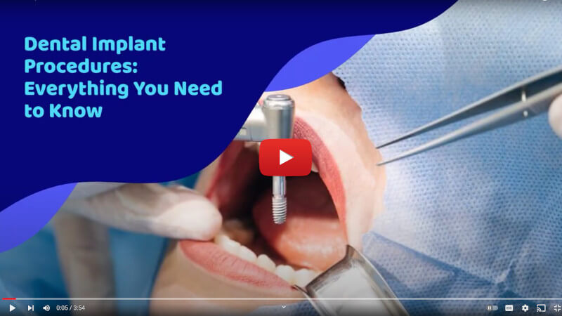 Dental implant information video.